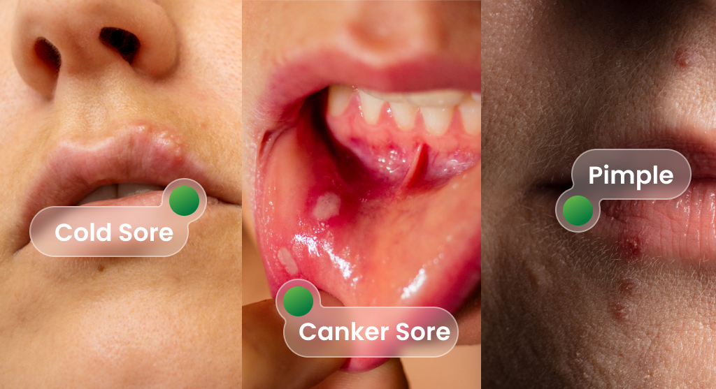 Comparison of cold sore vs canker sore vs pimpler