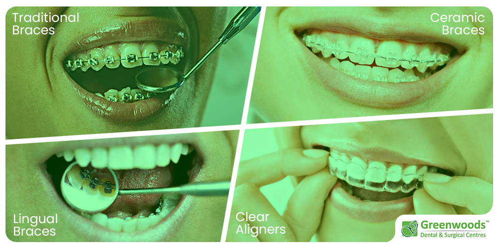 type of braces and aligners at Greenwoods Dental Centre