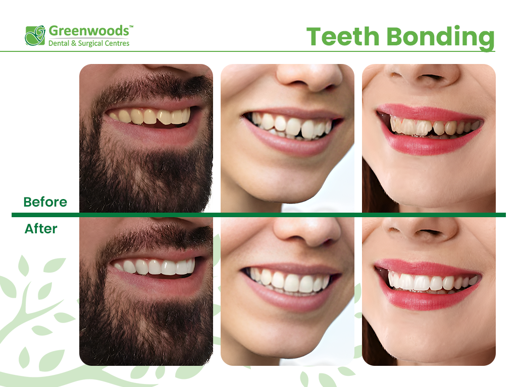Teeth Bonding Before And After Teeth Bonding Before And After