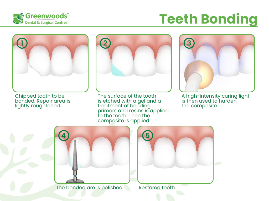Teeth Bonding Procedure Can Be Done in Only 1 Appointment The tooth bonding process in Winnipeg Dental Clinic