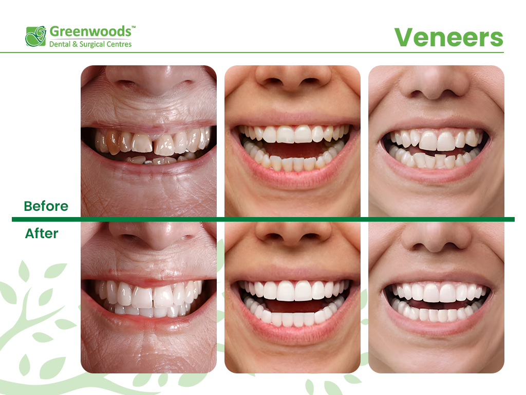 Veneers Before and After at Greenwoods Dental Centre