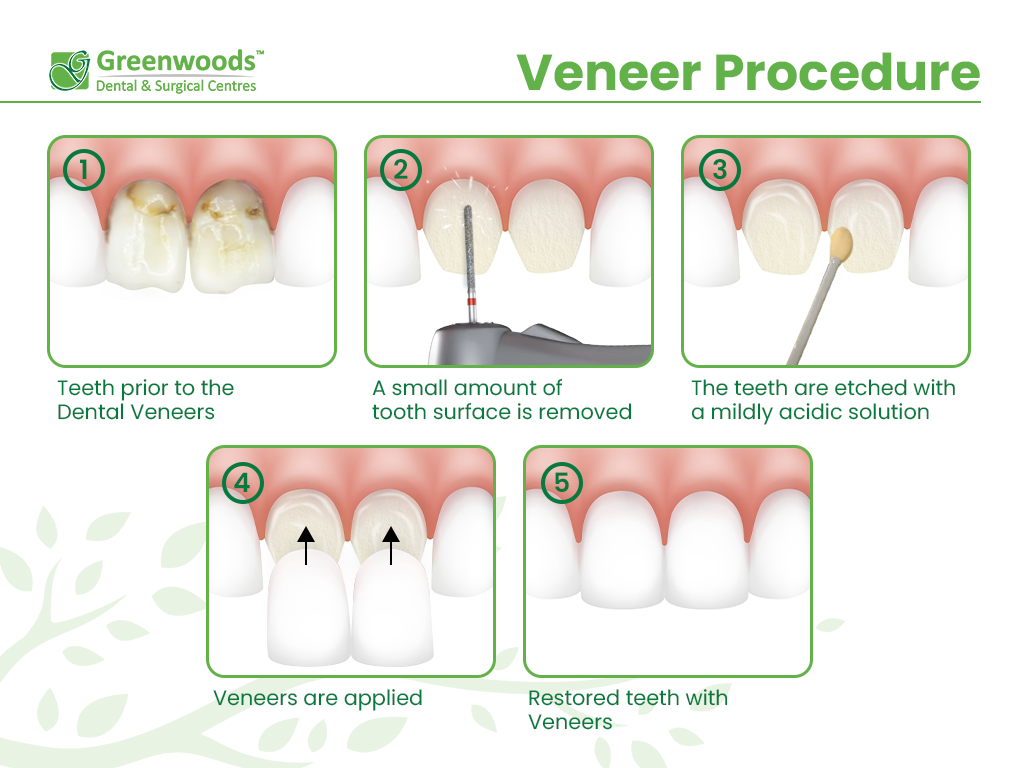 Veneers Procedure is usually done in 2 appointments Veneer Procedure
