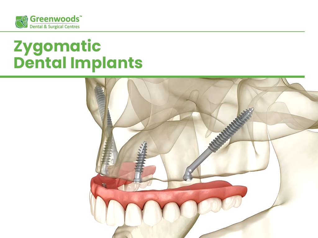 Scheme of Zygomatic Implants