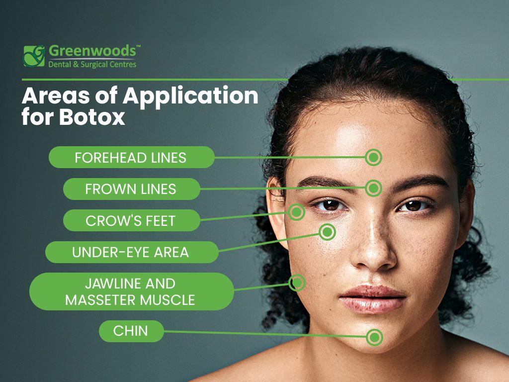 application areas for botox