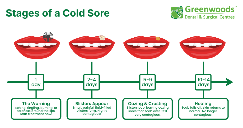 Stages of a cold core: warning, blisters appear, oozing and crusting, healing