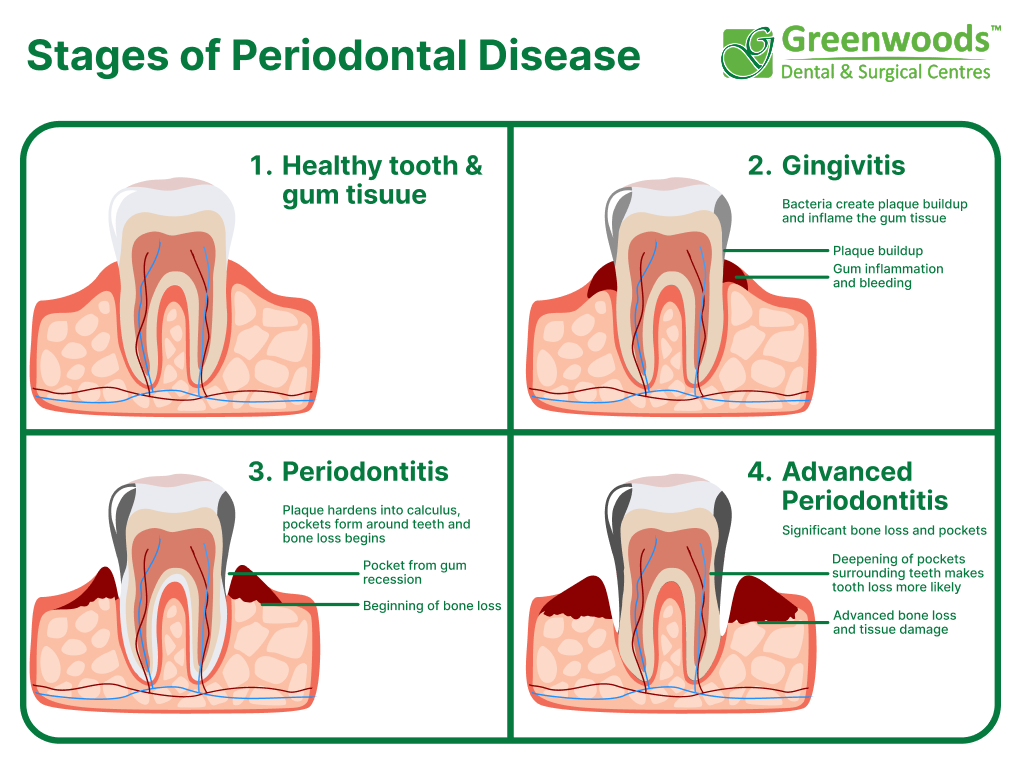 Stages of Periodontal Disease