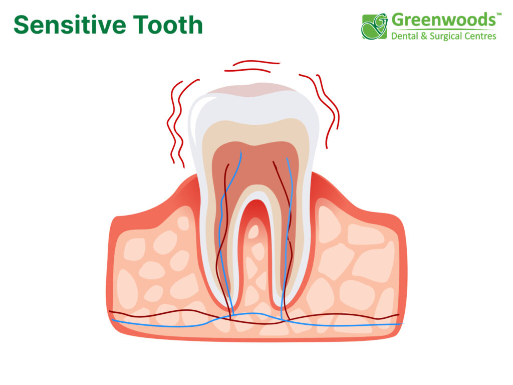 Sensitivity in the tooth