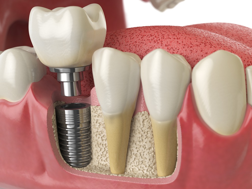single tooth molar dental implant